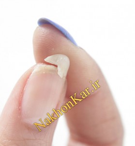 ترمیم ناخن شکسته , روش ترمیم ناخن شکسته ,نحوه ترمیم ناخن شکسته