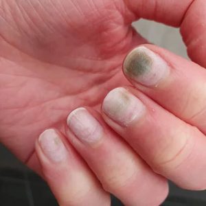 علت قارچ شدن ناخن کاشت